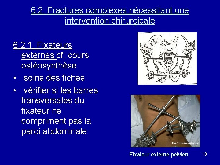 6. 2. Fractures complexes nécessitant une intervention chirurgicale 6. 2. 1. Fixateurs externes cf.