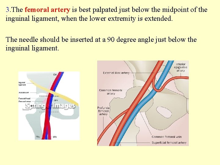 3. The femoral artery is best palpated just below the midpoint of the inguinal