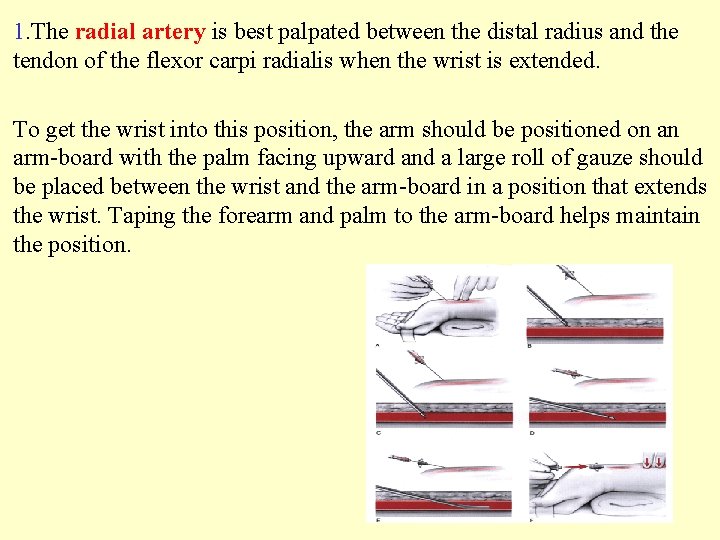 1. The radial artery is best palpated between the distal radius and the tendon