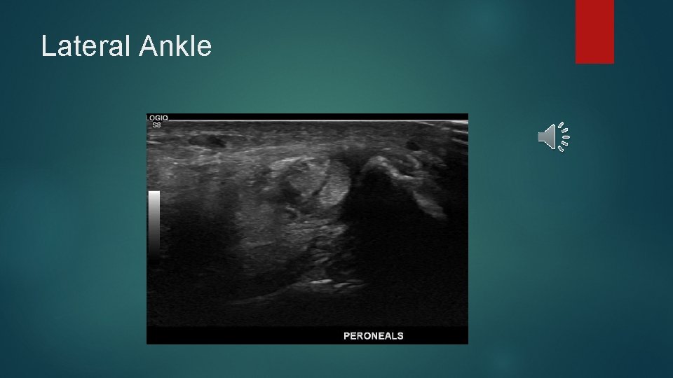 Lateral Ankle 