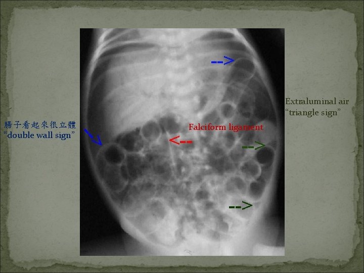 Extraluminal air “triangle sign” 腸子看起來很立體 “double wall sign” Falciform ligament 