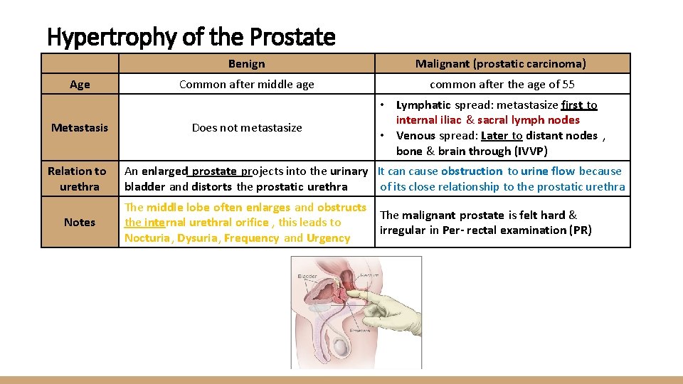 Hypertrophy of the Prostate Age Metastasis Relation to urethra Notes Benign Malignant (prostatic carcinoma)