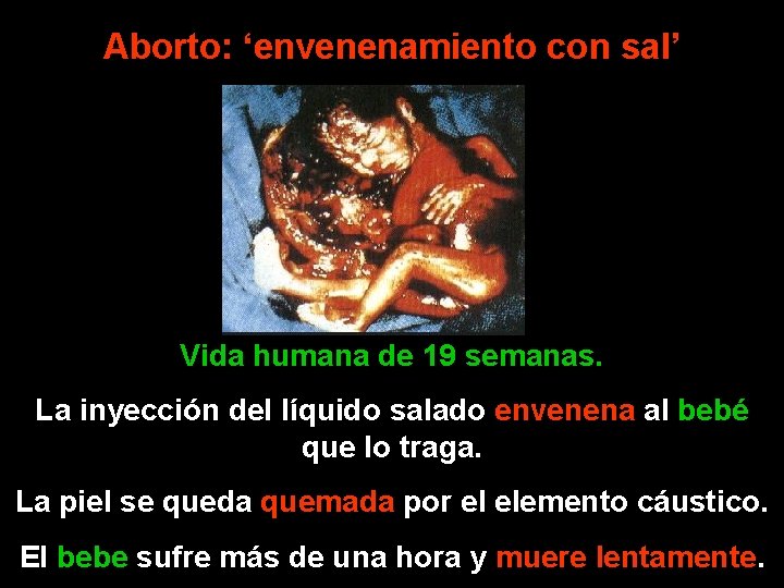 Aborto: ‘envenenamiento con sal’ Vida humana de 19 semanas. La inyección del líquido salado