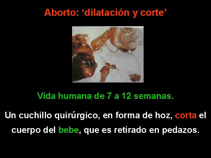 Aborto: ‘dilatación y corte’ Vida humana de 7 a 12 semanas. Un cuchillo quirúrgico,