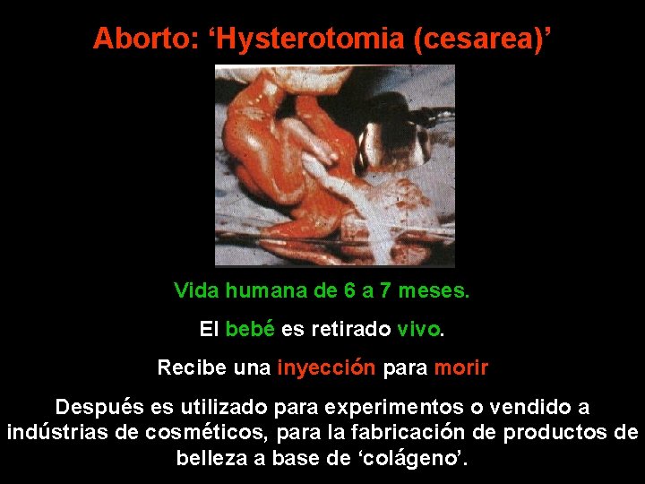 Aborto: ‘Hysterotomia (cesarea)’ Vida humana de 6 a 7 meses. El bebé es retirado