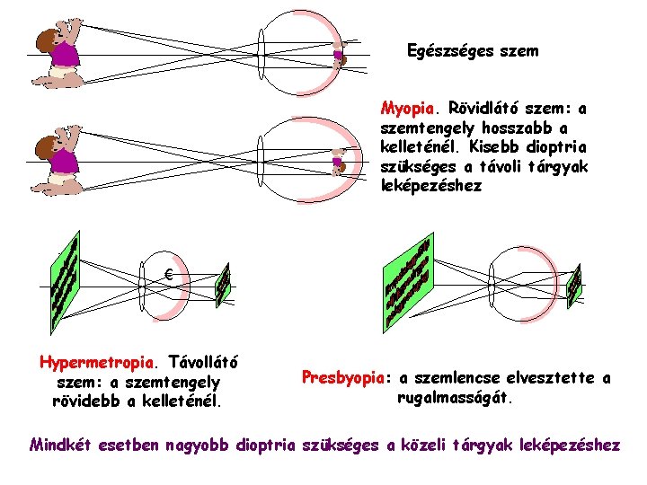 Egészséges szem Myopia. Rövidlátó szem: a szemtengely hosszabb a kelleténél. Kisebb dioptria szükséges a Egészséges szem Myopia. Rövidlátó szem: a szemtengely hosszabb a kelleténél. Kisebb dioptria szükséges a