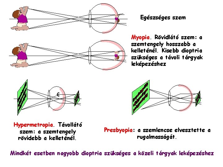 Egészséges szem Myopia. Rövidlátó szem: a szemtengely hosszabb a kelleténél. Kisebb dioptria szükséges a