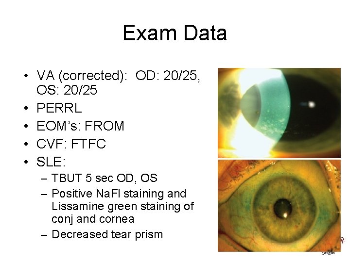 Exam Data • VA (corrected): OD: 20/25, OS: 20/25 • PERRL • EOM’s: FROM