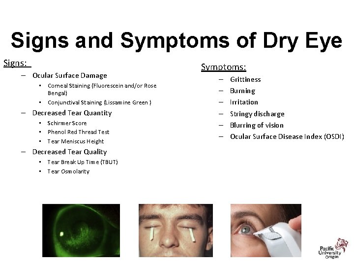 Signs and Symptoms of Dry Eye Signs: – Ocular Surface Damage • Corneal Staining
