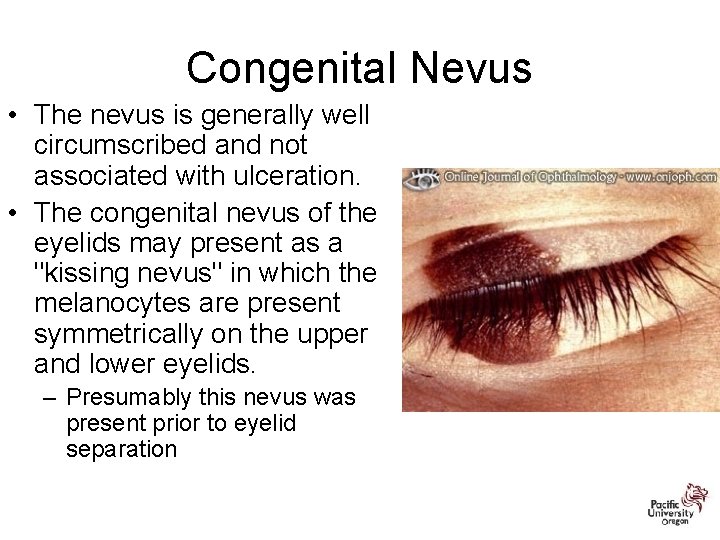 Congenital Nevus • The nevus is generally well circumscribed and not associated with ulceration.