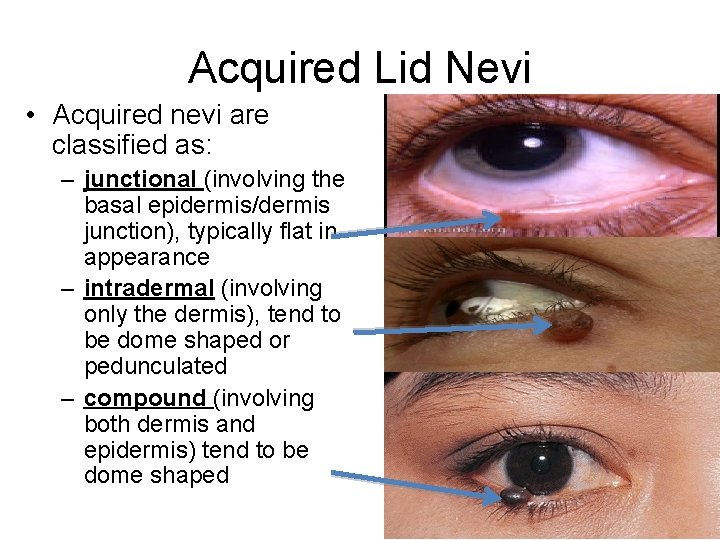 Acquired Lid Nevi • Acquired nevi are classified as: – junctional (involving the basal