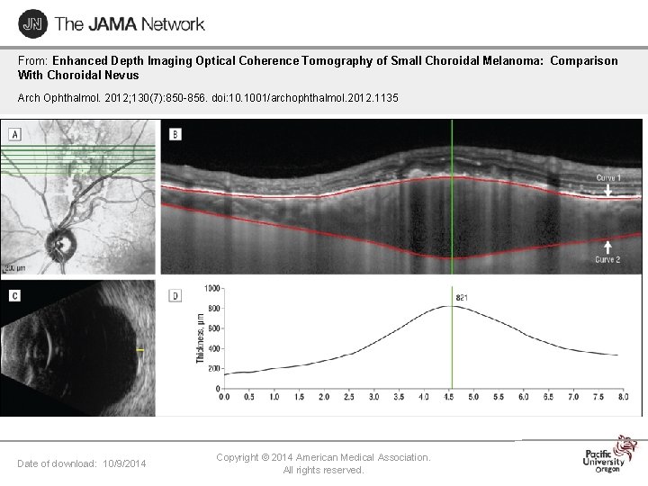 From: Enhanced Depth Imaging Optical Coherence Tomography of Small Choroidal Melanoma: Comparison With Choroidal