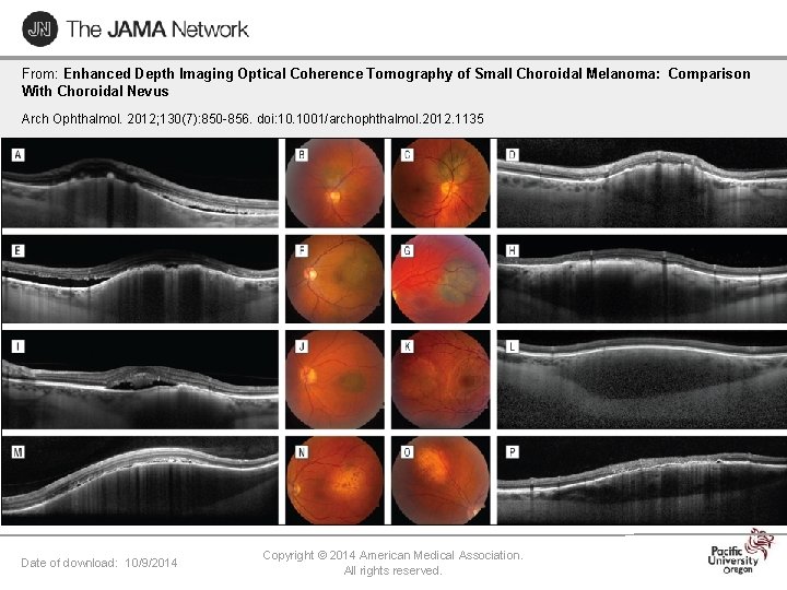 From: Enhanced Depth Imaging Optical Coherence Tomography of Small Choroidal Melanoma: Comparison With Choroidal