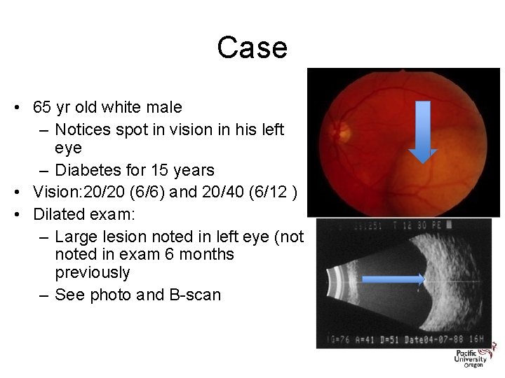 Case • 65 yr old white male – Notices spot in vision in his