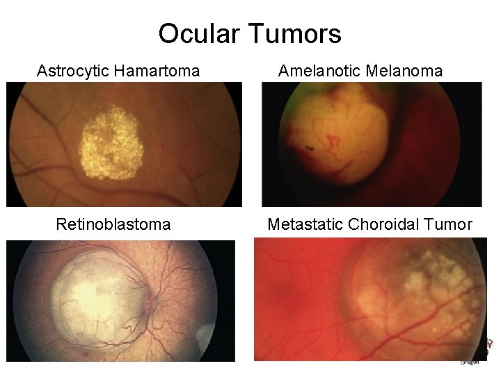 Ocular Tumors Astrocytic Hamartoma Retinoblastoma Amelanotic Melanoma Metastatic Choroidal Tumor 