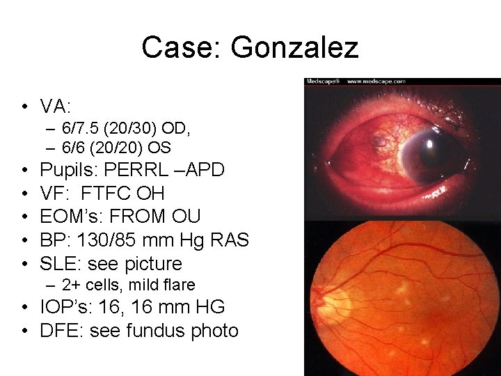 Case: Gonzalez • VA: – 6/7. 5 (20/30) OD, – 6/6 (20/20) OS •
