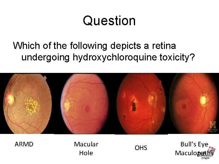 Question Which of the following depicts a retina undergoing hydroxychloroquine toxicity? ARMD Macular Hole