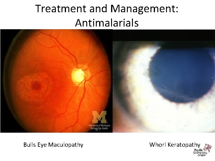 Treatment and Management: Antimalarials 29 Bulls Eye Maculopathy Whorl Keratopathy 