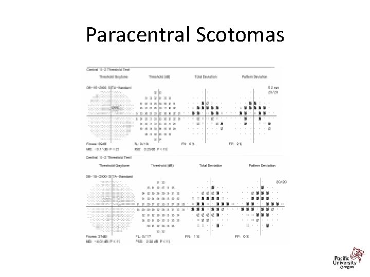 Paracentral Scotomas 