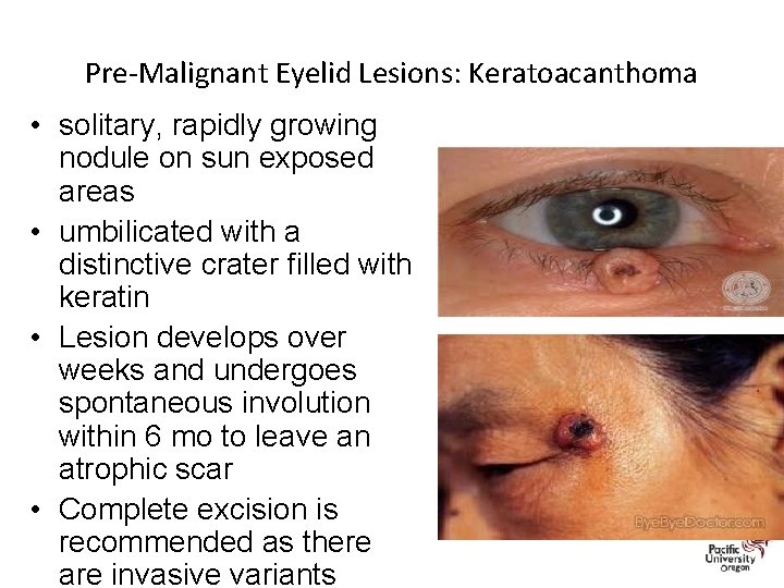 Pre-Malignant Eyelid Lesions: Keratoacanthoma • solitary, rapidly growing nodule on sun exposed areas •