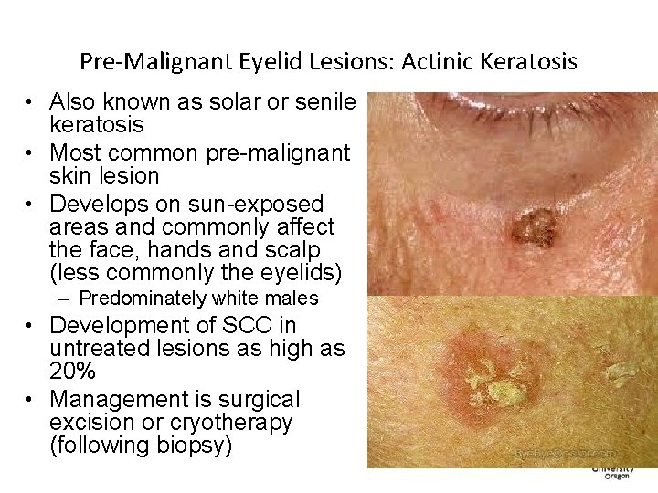 Pre-Malignant Eyelid Lesions: Actinic Keratosis • Also known as solar or senile keratosis •