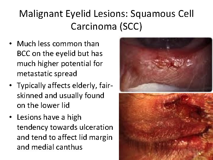 Malignant Eyelid Lesions: Squamous Cell Carcinoma (SCC) • Much less common than BCC on