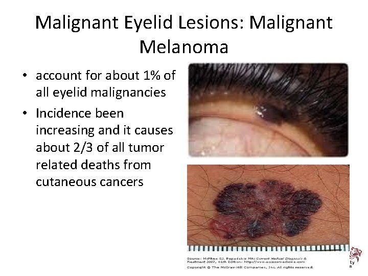 Malignant Eyelid Lesions: Malignant Melanoma • account for about 1% of all eyelid malignancies