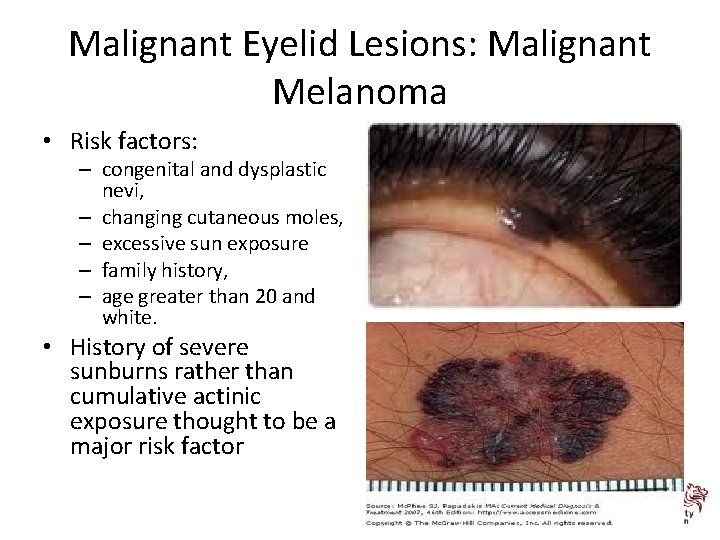Malignant Eyelid Lesions: Malignant Melanoma • Risk factors: – congenital and dysplastic nevi, –