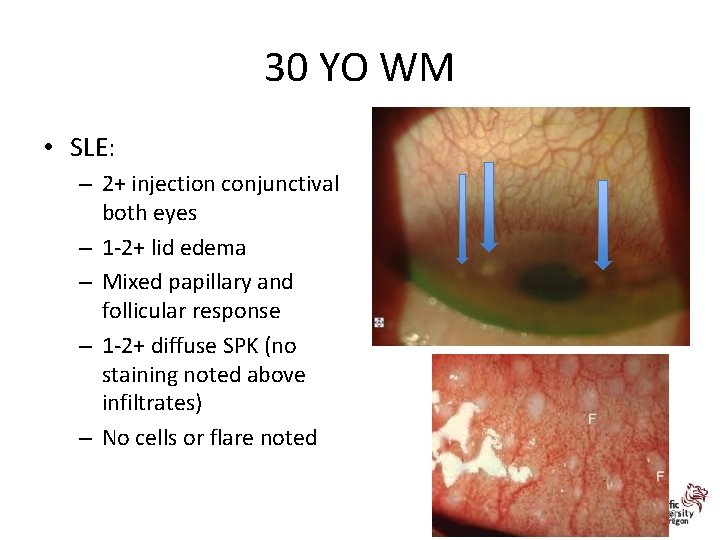 30 YO WM • SLE: – 2+ injection conjunctival both eyes – 1 -2+