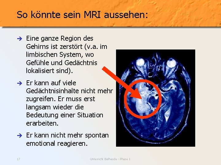 So könnte sein MRI aussehen: è Eine ganze Region des Gehirns ist zerstört (v.