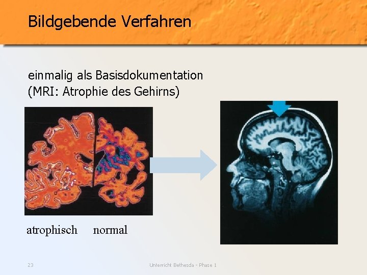 Bildgebende Verfahren einmalig als Basisdokumentation (MRI: Atrophie des Gehirns) atrophisch 23 normal Unterricht Bethesda