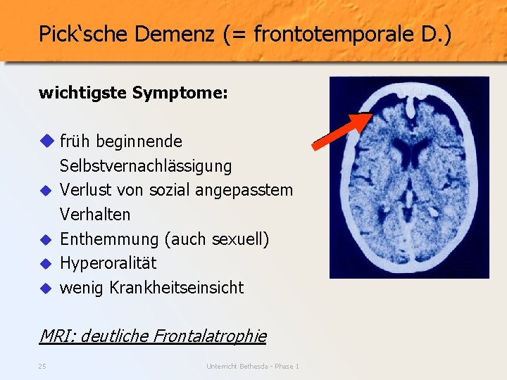 Pick‘sche Demenz (= frontotemporale D. ) wichtigste Symptome: u früh beginnende Selbstvernachlässigung u Verlust