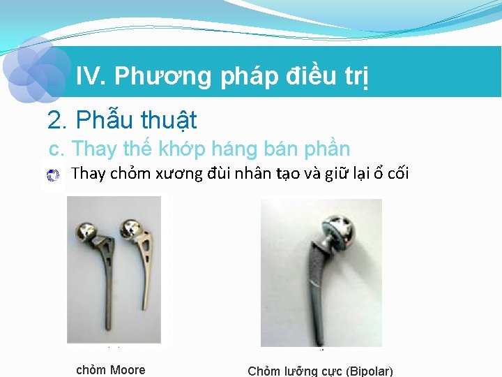 IV. Phương pháp điều trị 2. Phẫu thuật c. Thay thế khớp háng bán