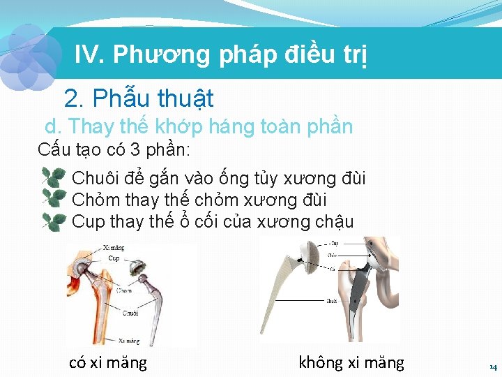 IV. Phương pháp điều trị 2. Phẫu thuật d. Thay thế khớp háng toàn