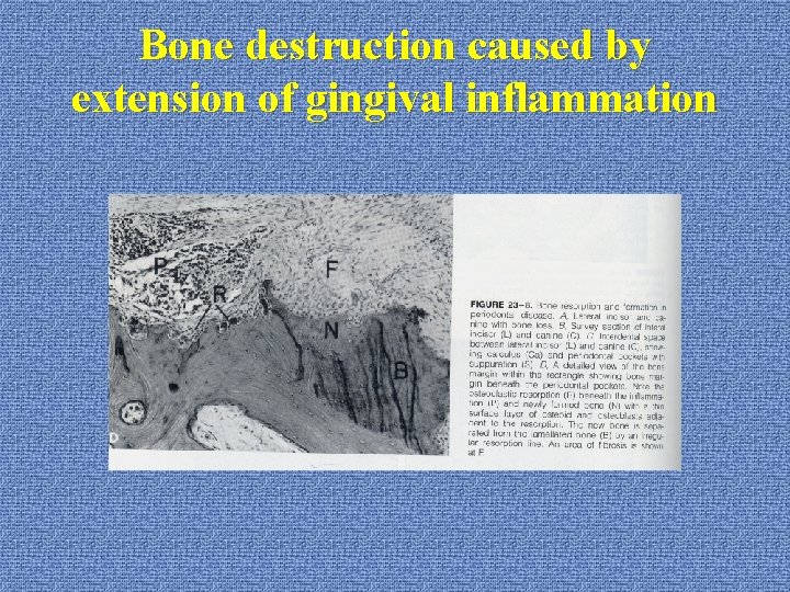 Bone destruction caused by extension of gingival inflammation 