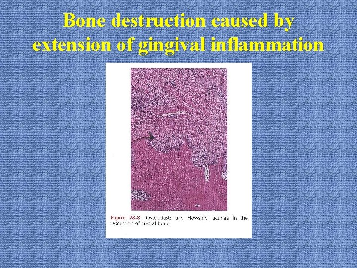 Bone destruction caused by extension of gingival inflammation 