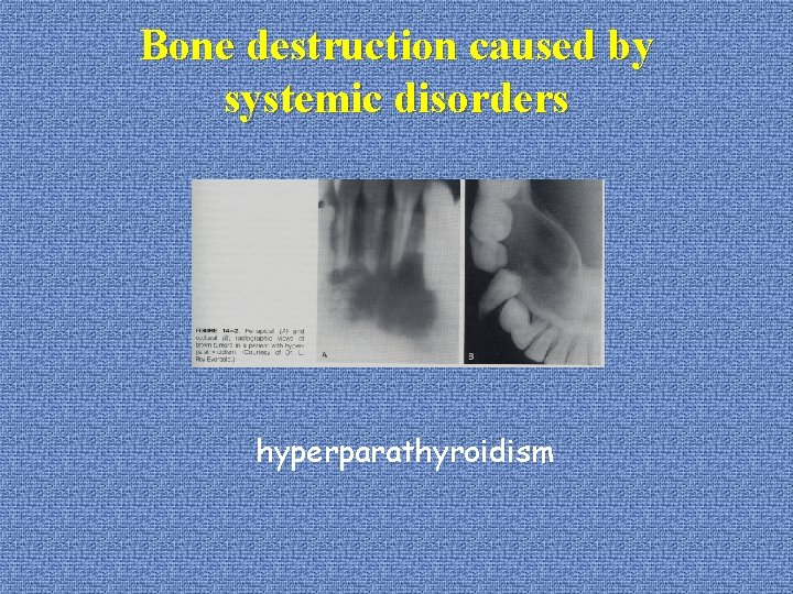 Bone destruction caused by systemic disorders hyperparathyroidism 