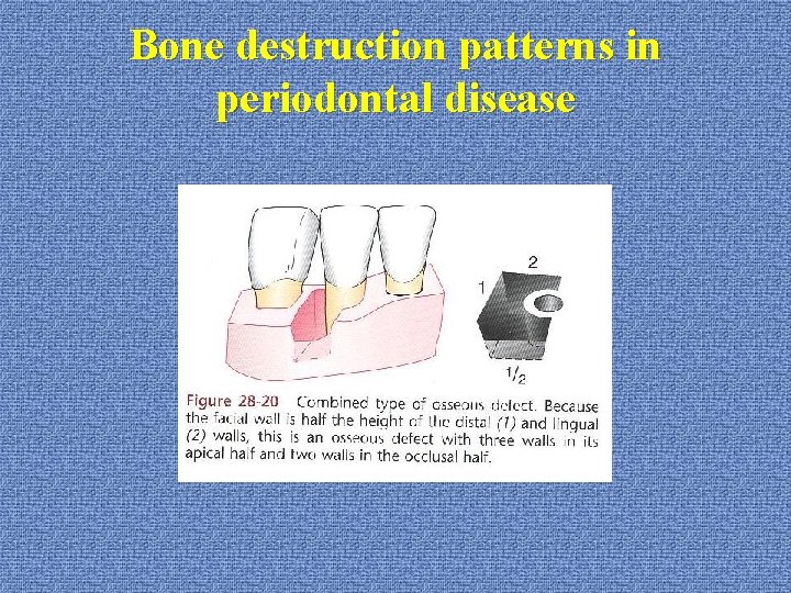 Bone destruction patterns in periodontal disease 