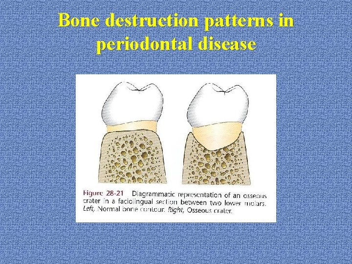 Bone destruction patterns in periodontal disease 