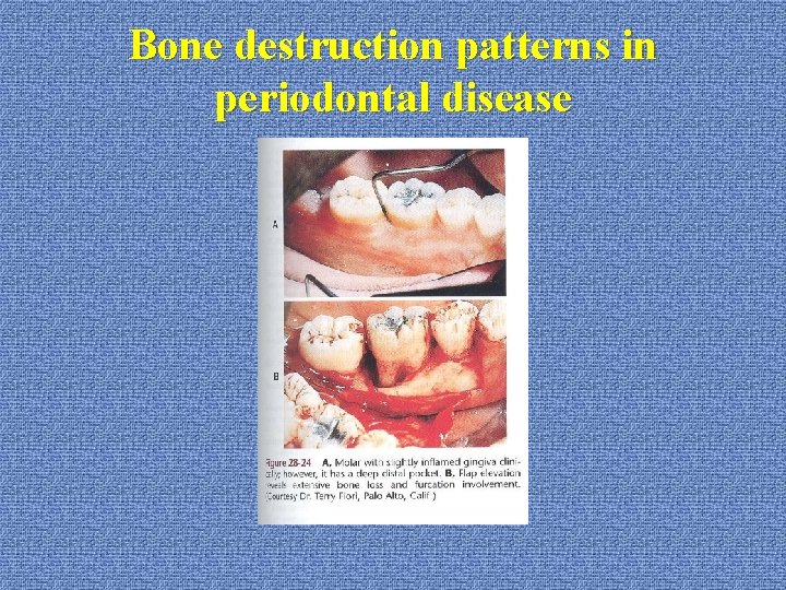 Bone destruction patterns in periodontal disease 