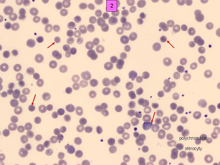 2 polychromázie sférocyty 