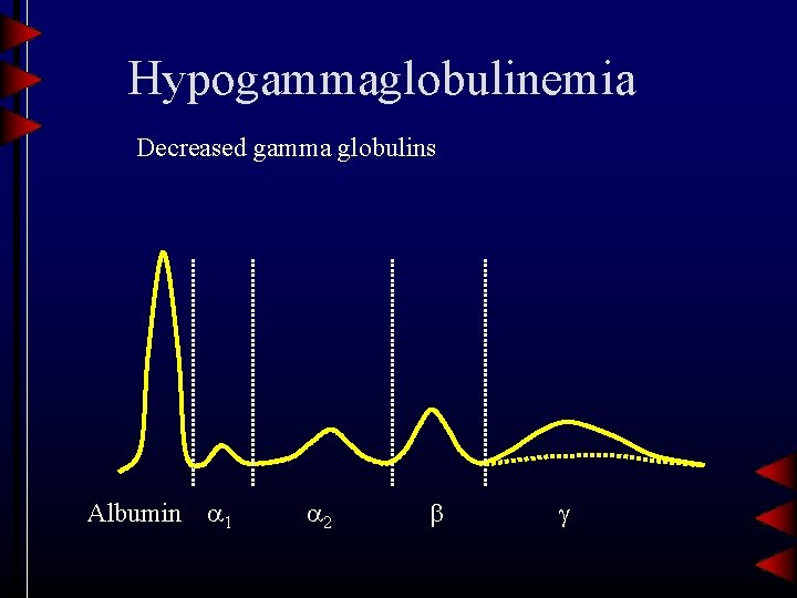 Hypogammaglobulinemia Decreased gamma globulins Albumin 1 2 