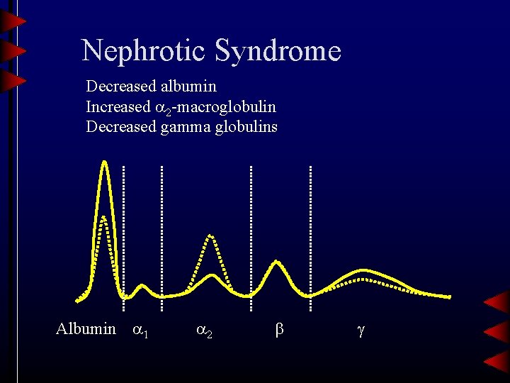 Nephrotic Syndrome Decreased albumin Increased 2 -macroglobulin Decreased gamma globulins Albumin 1 2 