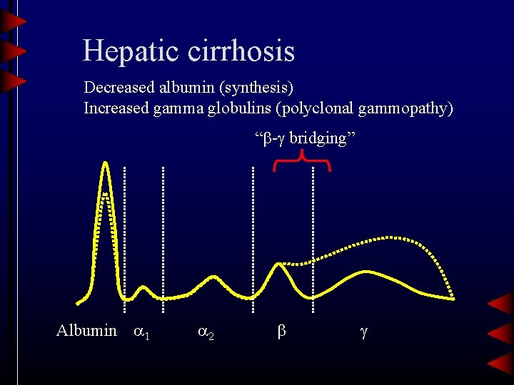 Hepatic cirrhosis Decreased albumin (synthesis) Increased gamma globulins (polyclonal gammopathy) “ - bridging” Albumin