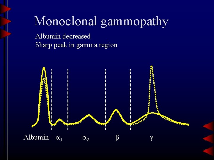 Monoclonal gammopathy Albumin decreased Sharp peak in gamma region Albumin 1 2 