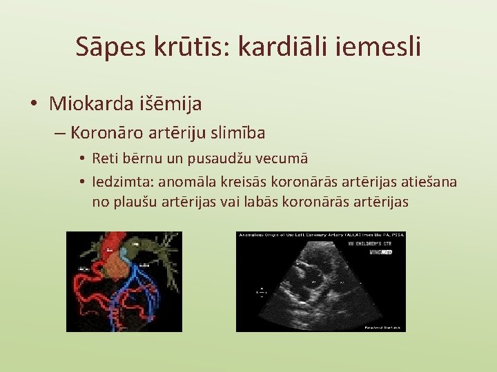 Sāpes krūtīs: kardiāli iemesli • Miokarda išēmija – Koronāro artēriju slimība • Reti bērnu