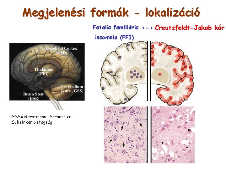 Megjelenési formák - lokalizáció Fatalis familiáris <-> Creutzfeldt-Jakob kór insomnia (FFI) GSS= Gerstmann –Straussler.