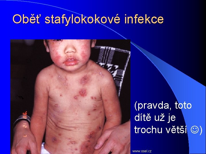 Oběť stafylokokové infekce (pravda, toto dítě už je trochu větší ) www. osel. cz