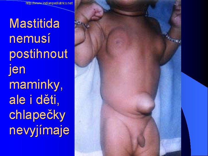  http: //www. indianpediatrics. net Mastitida nemusí postihnout jen maminky, ale i děti, chlapečky