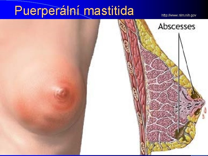 Puerperální mastitida http: //www. nlm. nih. gov 